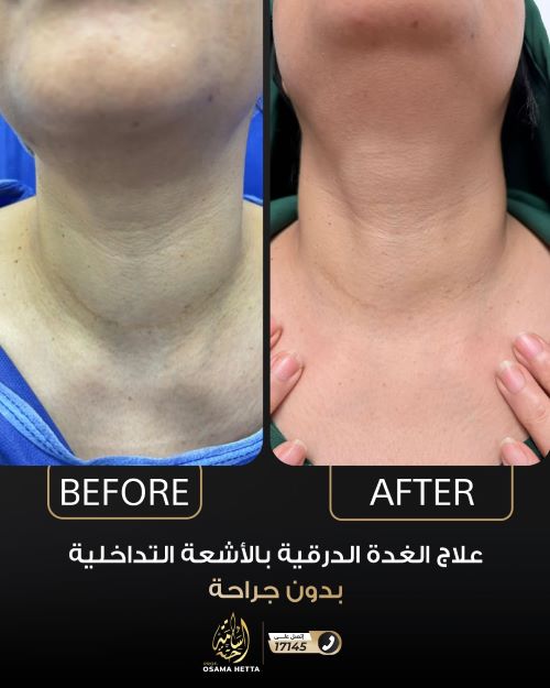 قبل وبعد علاج الغدة الدرقية بالأشعة التداخلية
